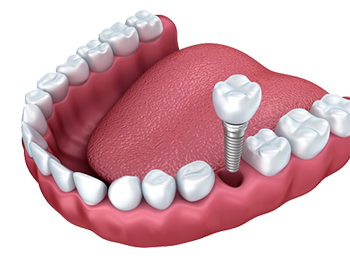 dental implants southern pines, nc